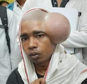 कमाल कर दिया चिकित्सकों की टीम ने-शासकीय चिकित्सा महाविद्यालय, अंबिकापुर में विशाल स्कैल्प डर्मॉइड सिस्ट का सफल ऑपरेशन. मरीजो के परियों ने किया धन्यवाद kshititech